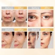 RF EMS LED Light Therapy Skin Care